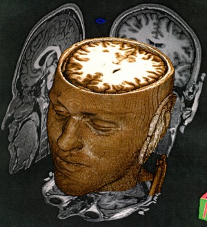 3D MRI 3D MRI